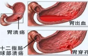 创新 | 植物药多司马酯构筑全消化道“保护盾”