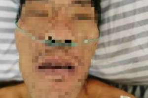 伟人杰克来了多学科联合治疗成功救治垂体瘤卒中患者