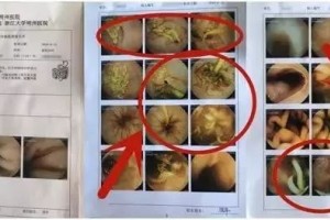68岁慈溪女子黑便1个月医生检查后发现肚子里全是虫!