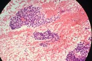 病理沙龙考虑甲状腺乳头状癌