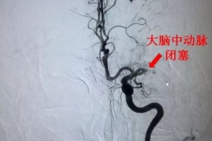 构筑脑梗死最后一道防线——神经内科三病区正式开科