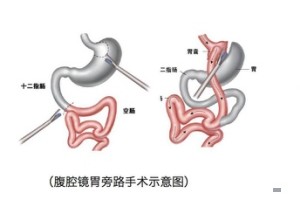 糖尿病是胰岛素多还是胰岛素少