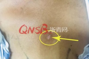 可怕60多岁大伯割草时一根钢针突然飞入胸腔直逼心脏……