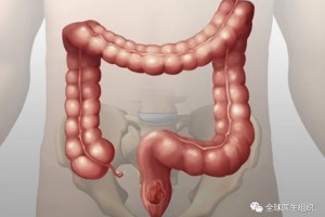 科普谈谈结直肠癌的细胞免疫疗法和早期筛查健康管理