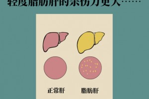 轻度脂肪肝的杀伤力可能更大……