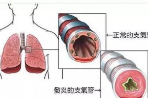慢性支气管炎--慢阻肺--肺气肿（慢阻肺晚期）--肺心病