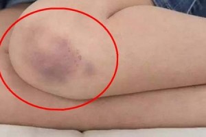 身上总是突然青一块紫一块可能是白血病看完终于明白