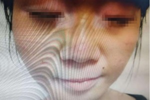 女子得怪病精力紧绷掉发幸得朋友协助获恢复了