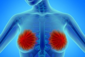 十种简单和乳腺癌混杂的疾病第四种能够高达70%