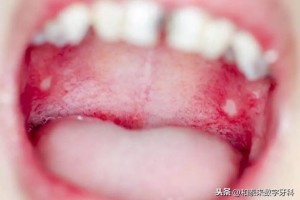 这种口腔溃疡可能是口腔癌口腔癌的几大预兆你中了吗