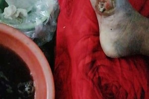 糖尿病足完全是可以用中医技能治好的