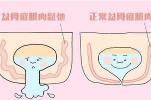 女人一打喷嚏一大笑就漏尿是怎么回事