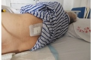 做右肾取石手术创伤在左腰部医院严峻差错会补偿丢失