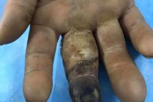 手指被竹签戳伤用土法医治竟导致截指糖尿病手要分外的留意这六点