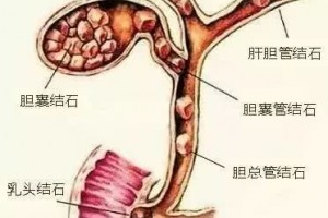 为啥不吃早餐容易得胆结石