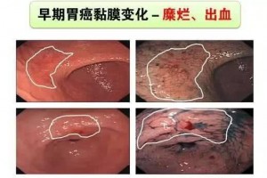 最前期的胃癌却差点丢了性命医师的一个行为救人一命