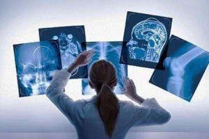 新AI东西可检测肺癌医治成效