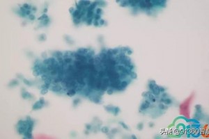病理沙龙考虑宫颈腺癌鳞癌
