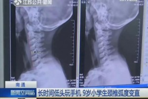 9岁小学生颈椎变成一条直线家长发现时已晚了许多孩子都有这习气