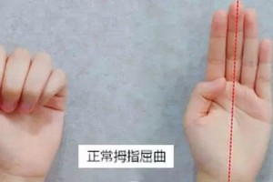 怎么辨别宝宝正常握拳和拇指内扣