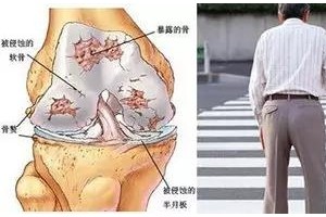 白叟上下楼膝盖疼警觉骨性关节炎
