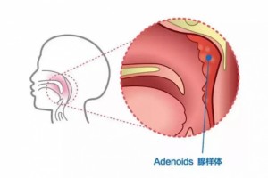 提示小儿腺样体肥壮的损害