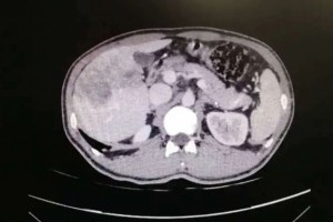 渭南市第二医院外二科(肿瘤胸外科)成功完结首例肝癌微波融化术