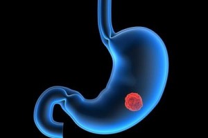 胃癌不管男女嘴里有3个反常你或许现已走向胃癌