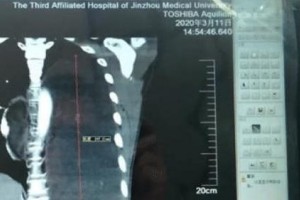 男人厌恶咳嗽3个月后就医查看胸腔中藏8斤肉瘤