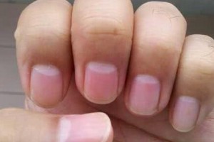 指甲呈现这些状况可能是体内疾病宣布的信号还请及时就诊