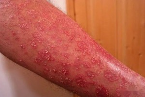 不知道生理盐水湿敷怎样操作让小姐姐来教教……